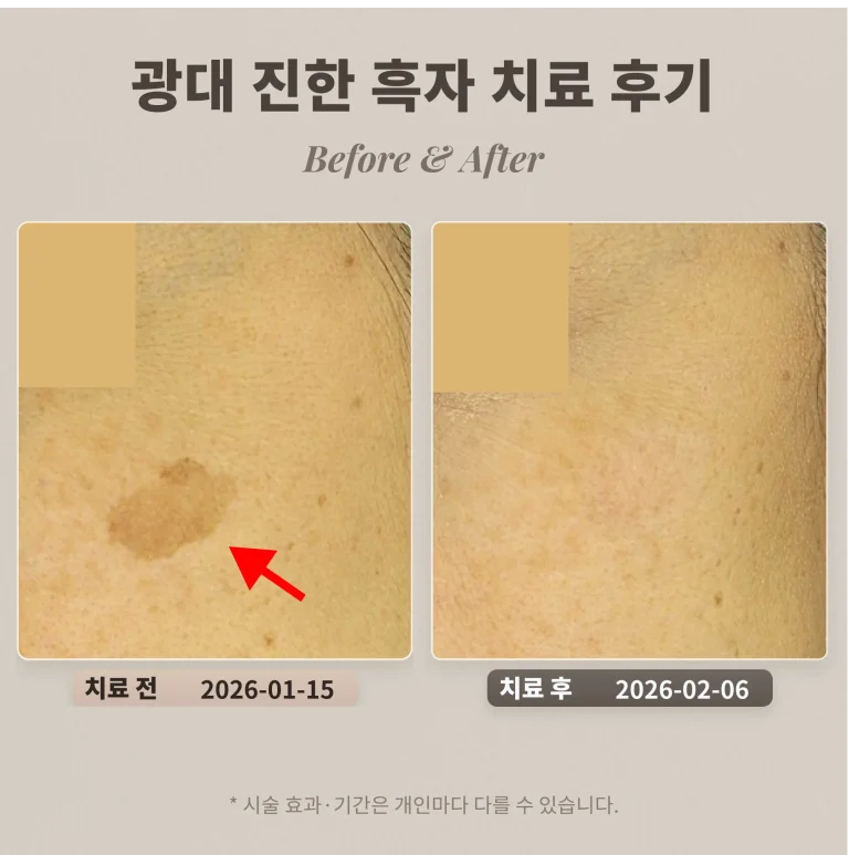 40대 여성 흑자 제거 후기_ 리팟레이저 후기