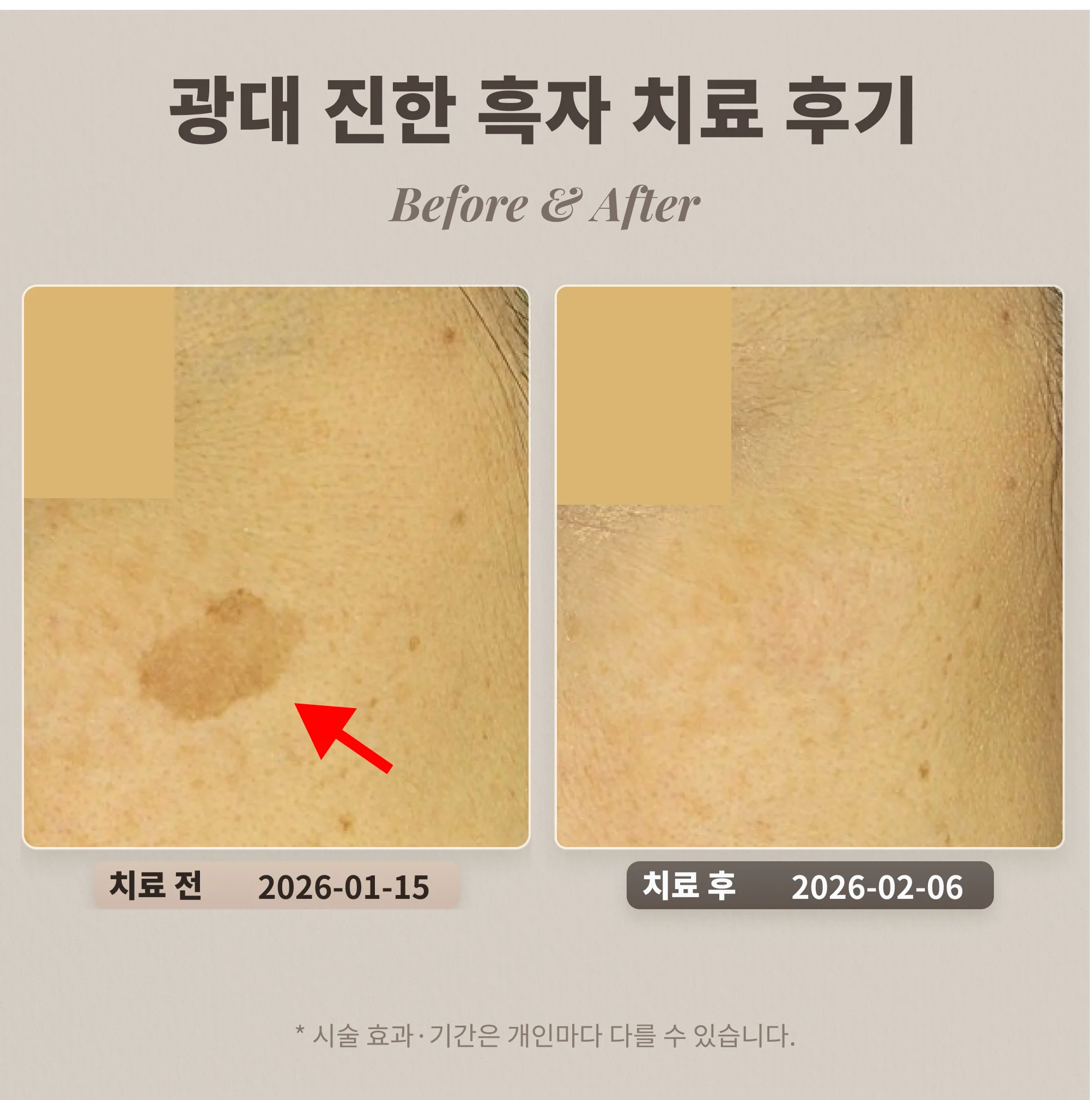 광대 진한 흑자 치료 후기