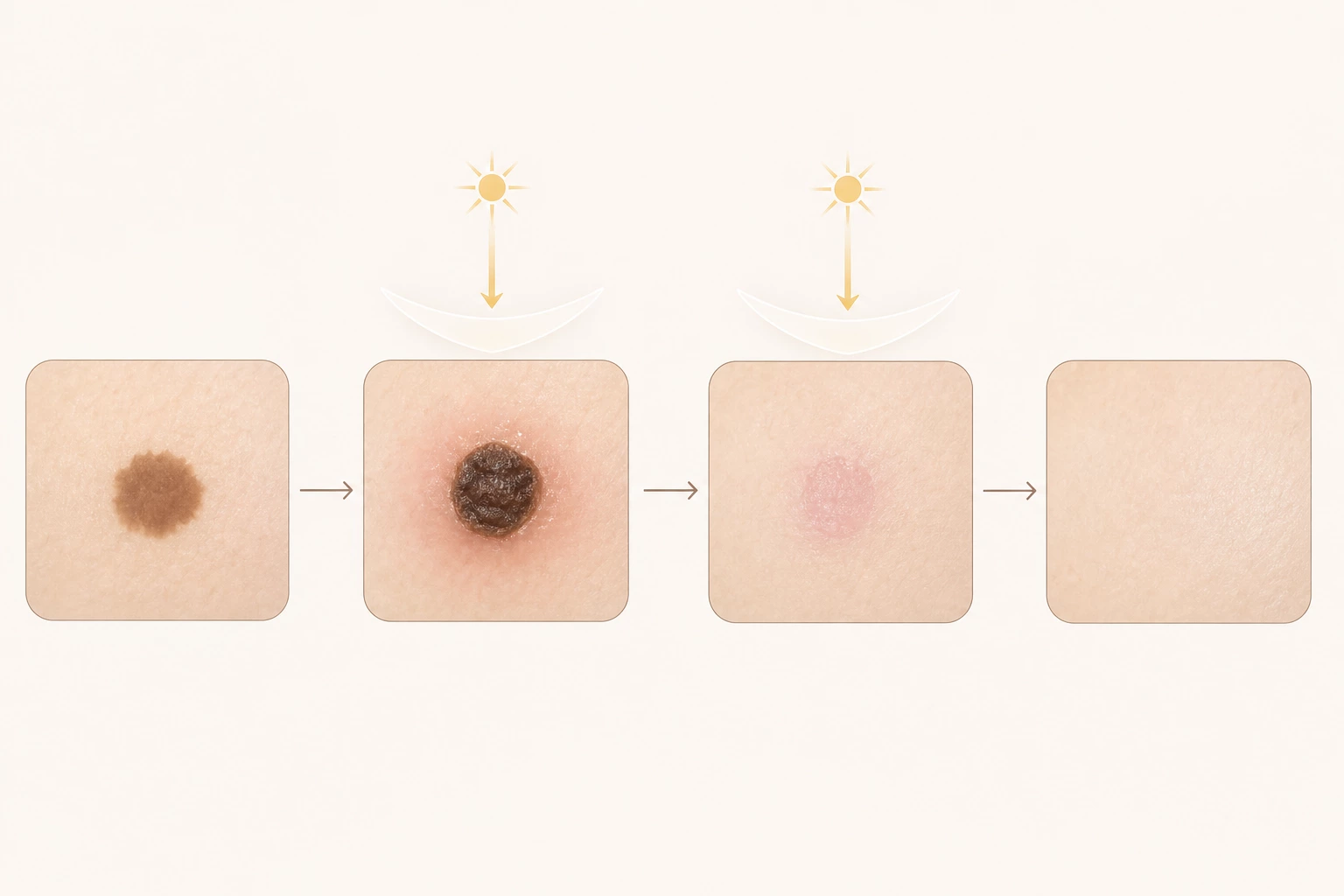 흑자 레이저 치료 후 딱지와 붉은 기가 가라앉는 회복 과정과 자외선 차단의 역할을 보여주는 도해