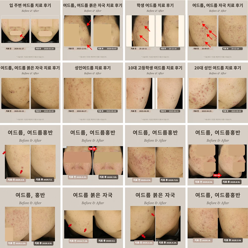 여드름 치료 사례 - 관자·볼 여드름과 붉은 자국 치료 전후