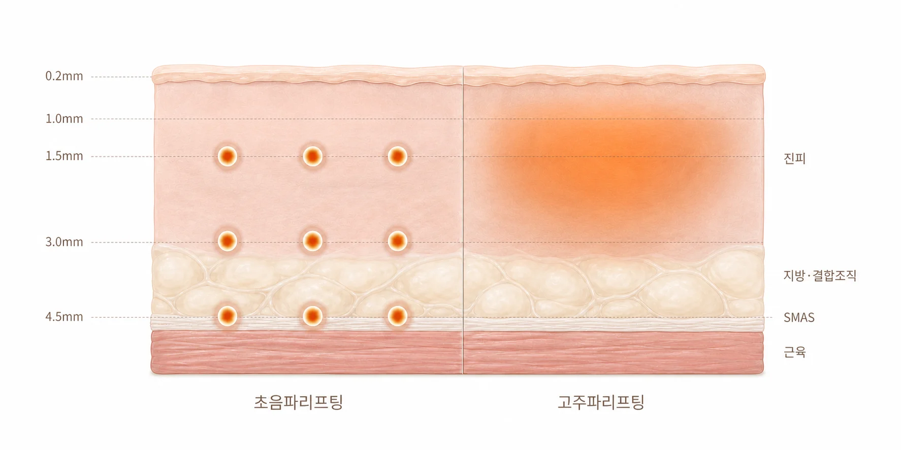 울쎄라 · 올리지오 · 써마지 비교 - 초음파리프팅과 고주파리프팅의 도달 층 차이