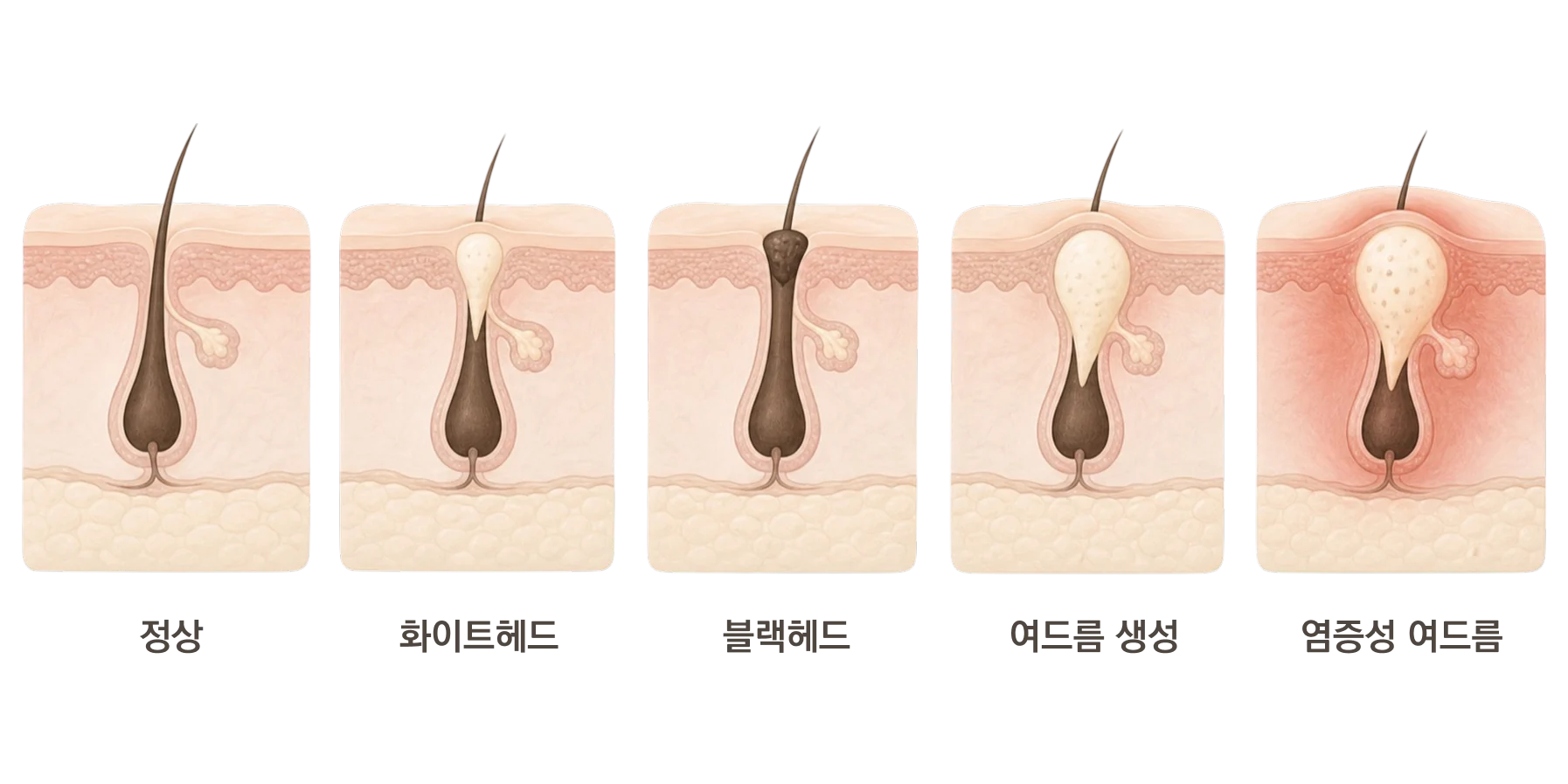 Acne progression infographic - from a normal pore to whiteheads, blackheads, acne formation, and worsening inflammatory acne