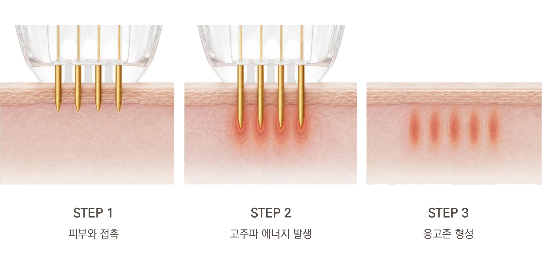 포텐자 여드름 치료 방법