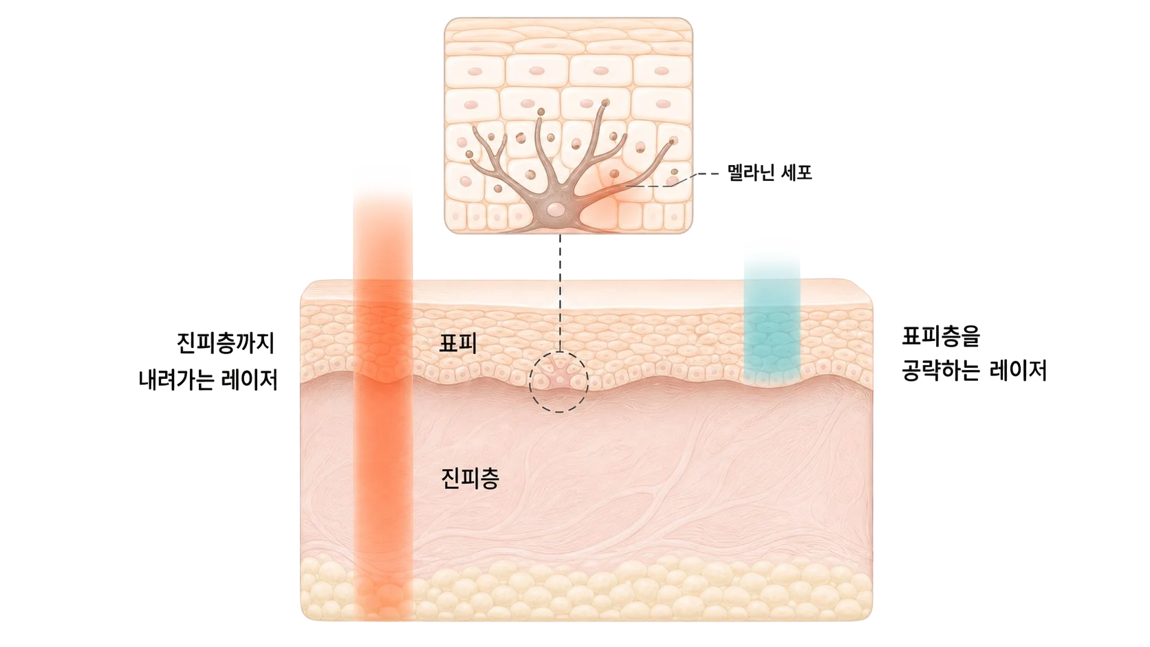 강한 레이저가 멜라닌 세포를 자극하는 레이저토닝 부작용 원리 도해