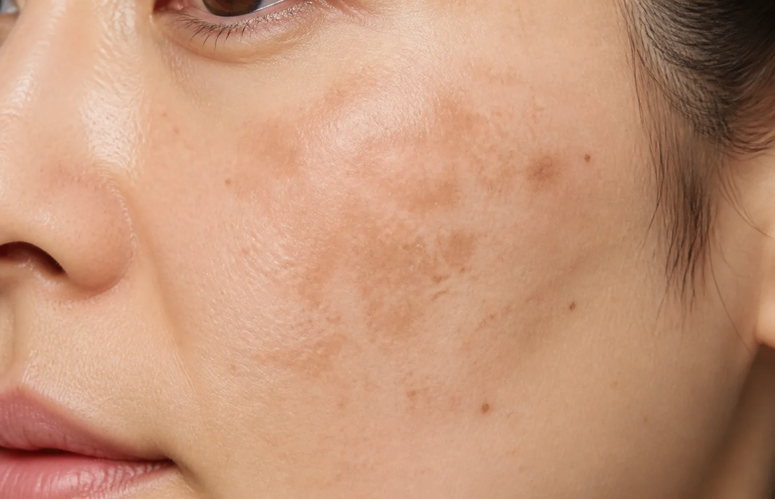 볼 주변에 기미가 번진 피부 - 기미치료, 피코토닝, 레이저토닝