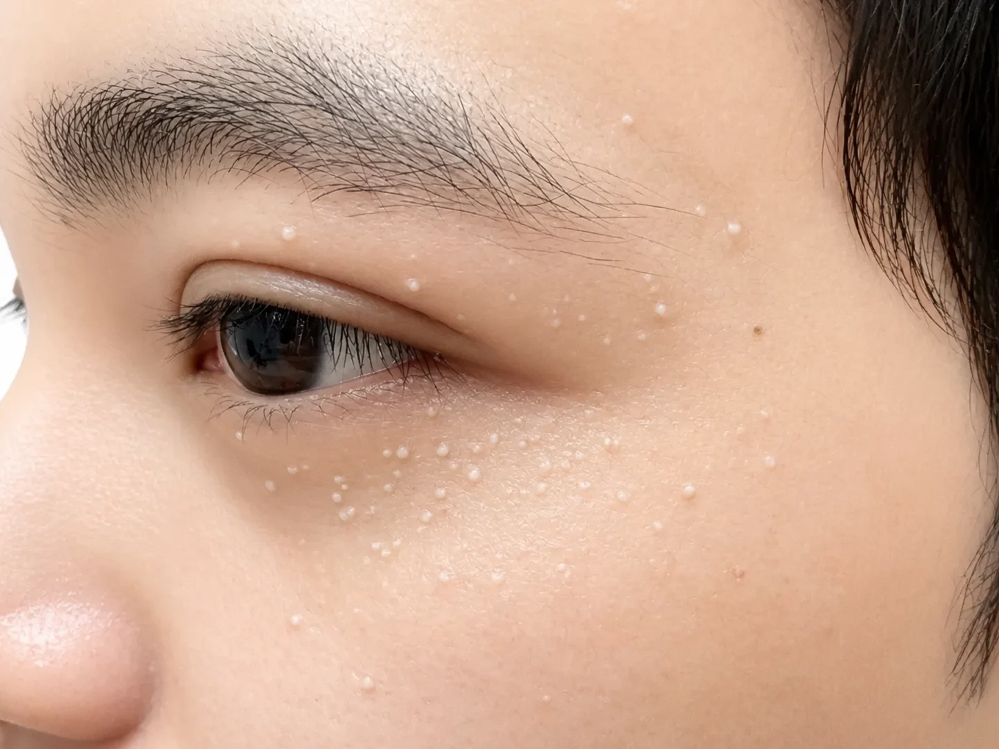 눈 주변에 하얗고 딱딱한 좁쌀 형태로 생긴 비립종 병변