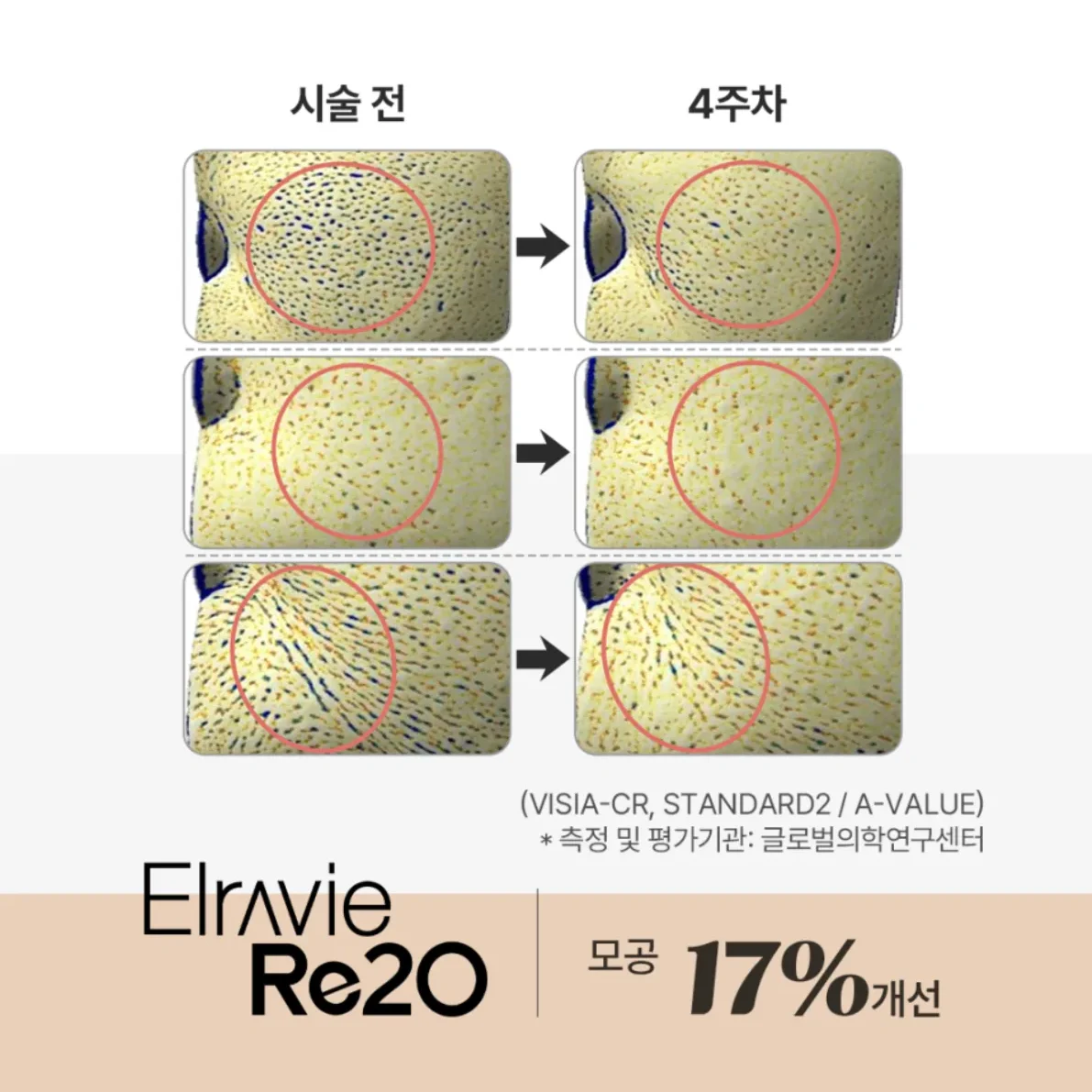VISIA-CR로 측정한 시술 전과 4주차의 모공 비교 이미지 - Elravie Re2O 임상 평가 자료
