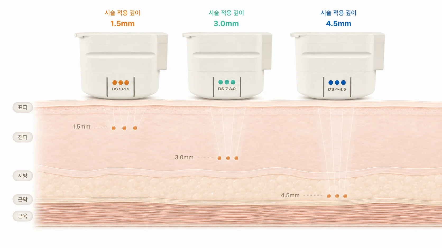 울쎄라의 원리 - 초음파 에너지가 피부 깊은 층에 열 응고점을 만드는 과정