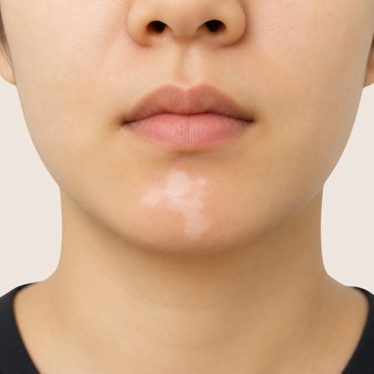 턱에 나타난 백반증 병변 - 치료가 늦어지면 확산될 수 있는 탈색반