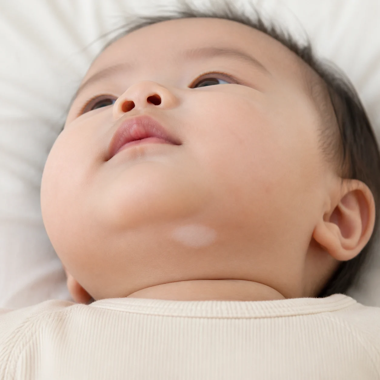 턱 아래 옅은 흰 반점이 관찰되는 아기 - 영유아 백반증 진단 상담 사례
