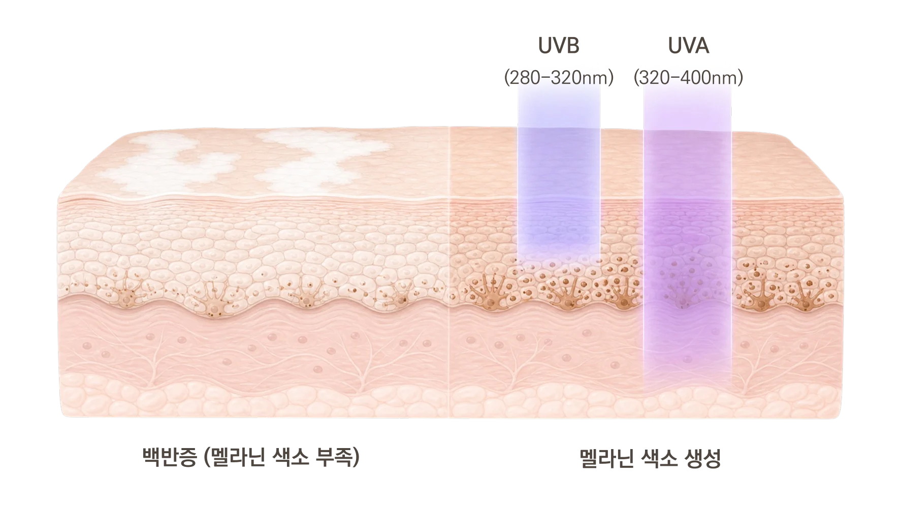 광선 치료 원리 도해 - 멜라닌 색소가 부족한 백반증 피부에 UVB·UVA를 조사하면 멜라닌 색소 생성이 유도되는 과정