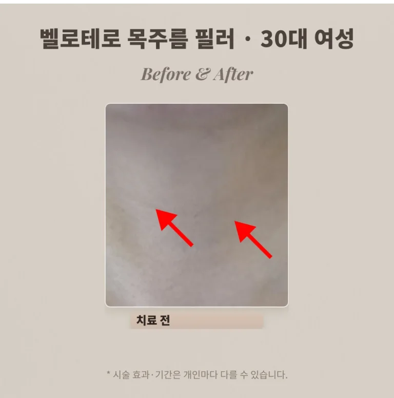 벨로테로 목주름 필러 후기, 30대 여성 정면 가로 주름