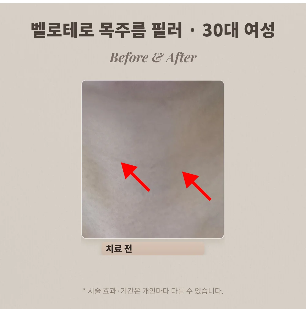 30대 여성 목주름 필러 시술 전 목 부위 확대