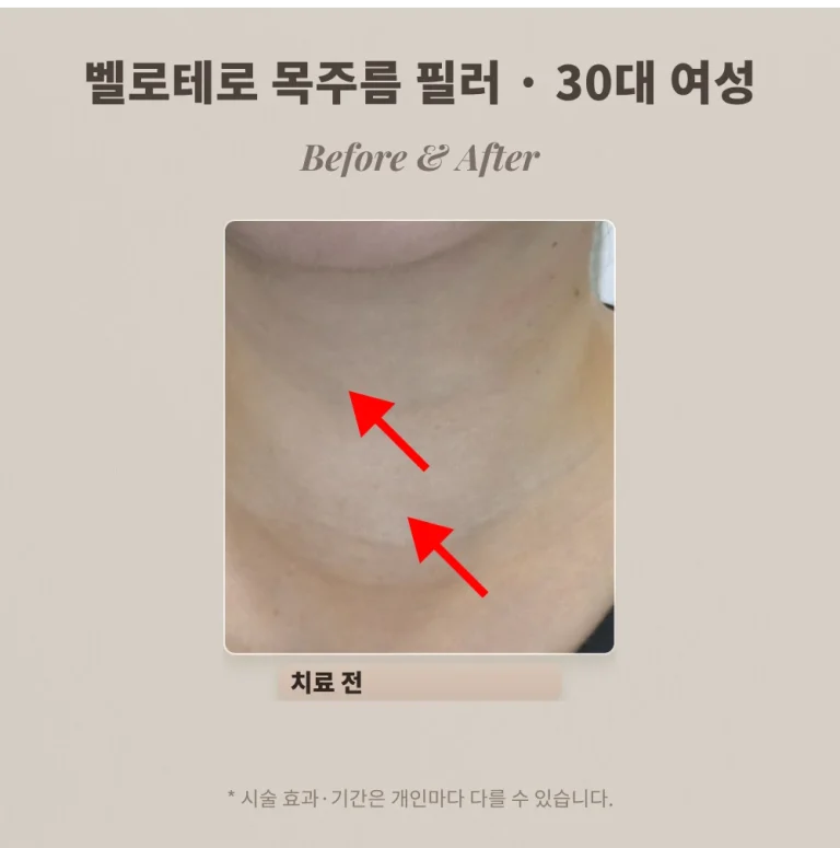 히알루론산 필러 목주름 시술, 30대 여성 벨로테로 전후