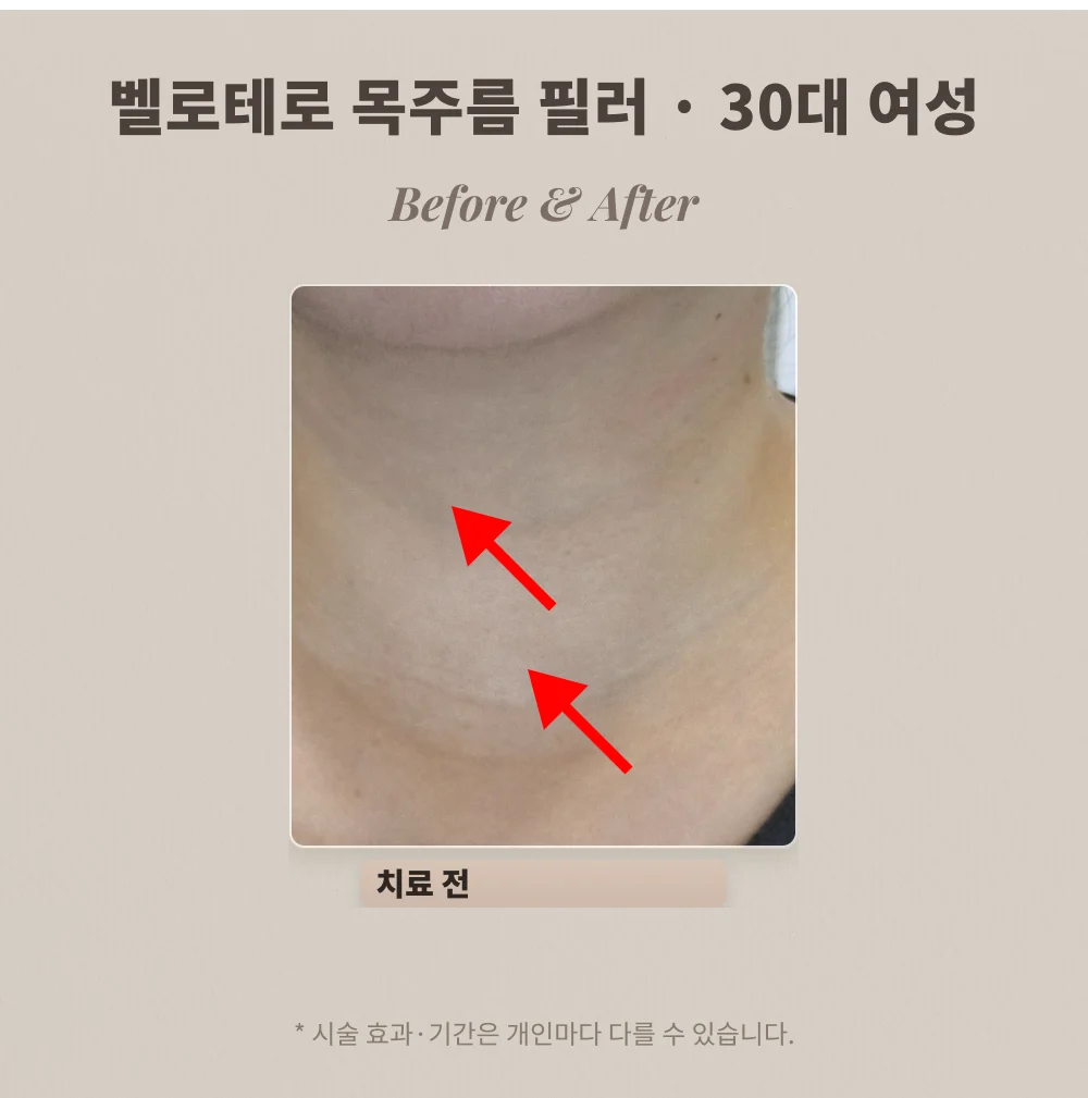30대 여성 목주름 히알루론산 필러 시술 전 목 부위 확대
