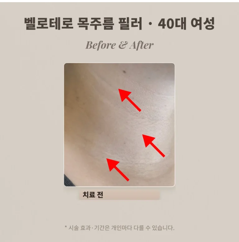 40대 옆목 주름 필러, 벨로테로로 채운 비스듬한 목주름