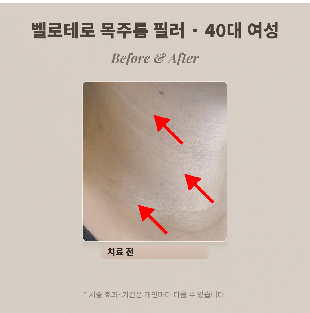 40대 여성 옆목 주름 필러 시술 전 목 부위 확대