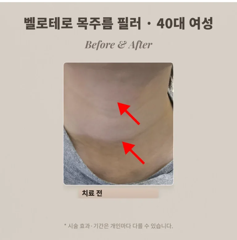 목주름 필러 시술 후기, 40대 여성 여러 줄 목주름