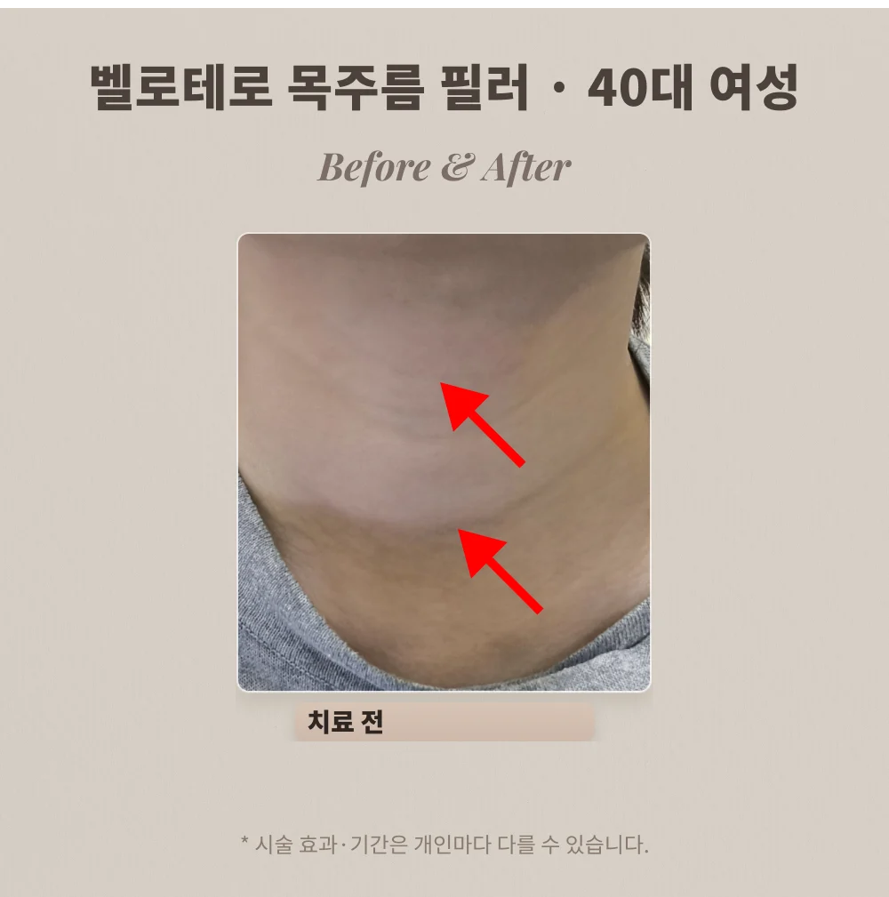 40대 여성 여러 줄 목주름 필러 시술 전 목 부위 확대