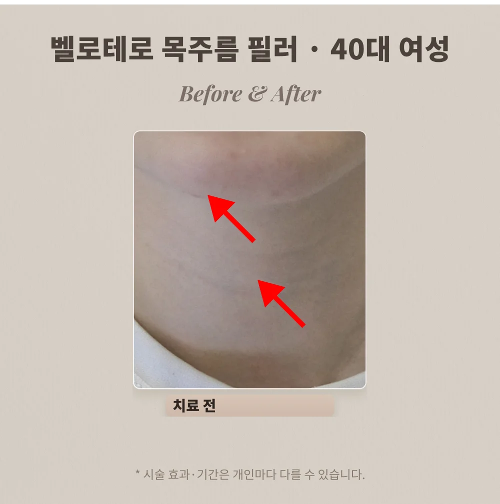40대 여성 목주름 필러 시술 전 목 부위 확대