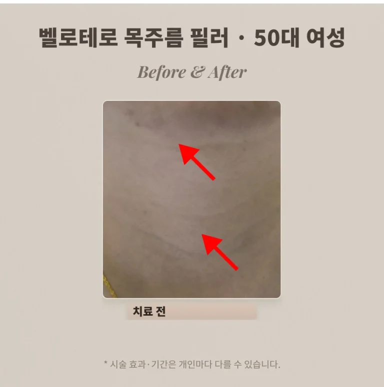 50대 여성 목주름 필러, 깊어진 가로 주름 벨로테로 시술