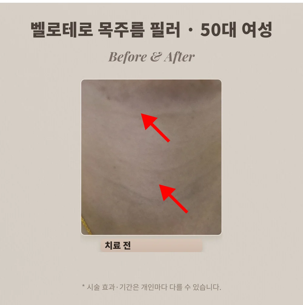 50대 여성 목주름 필러 시술 전 목 부위 확대