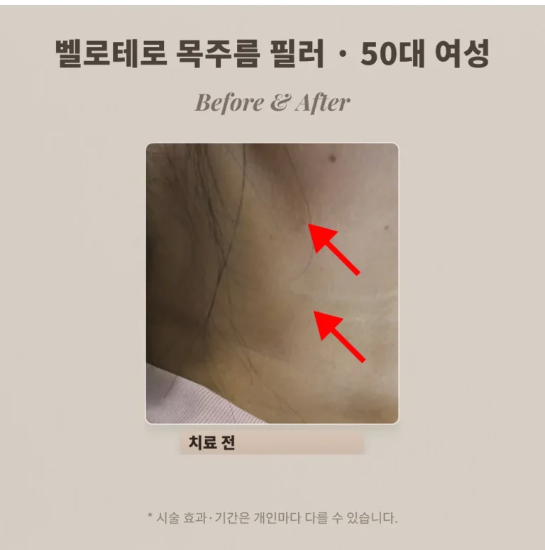 50대 목주름 필러 후기, 옆목 가로 주름 벨로테로 시술