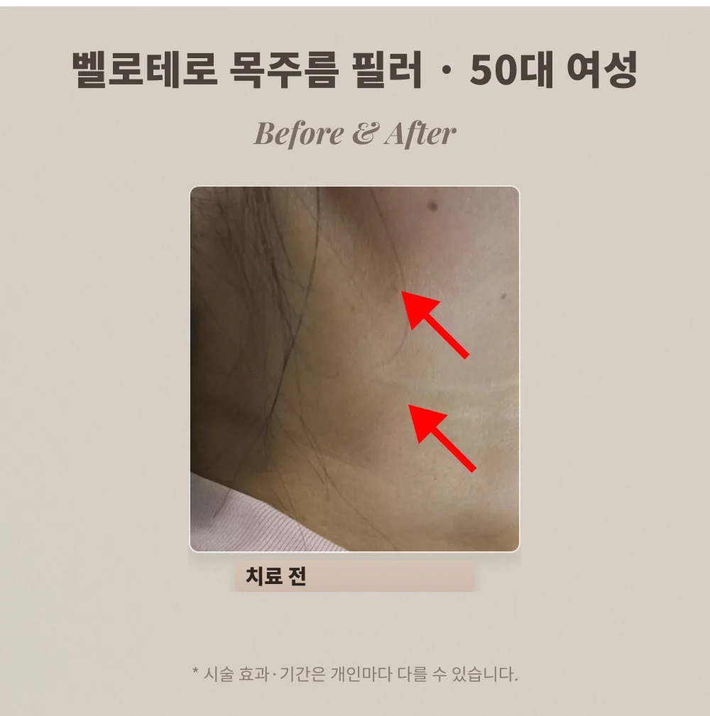 50대 여성 옆목 주름 필러 시술 전 목 부위 확대