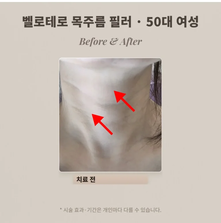 벨로테로 필러 두 줄 목주름, 50대 여성 시술 후기