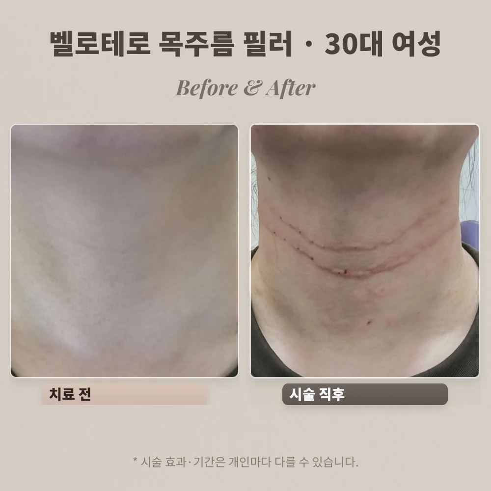 30대 여성 벨로테로 목주름 필러 시술 전과 시술 직후 비교
