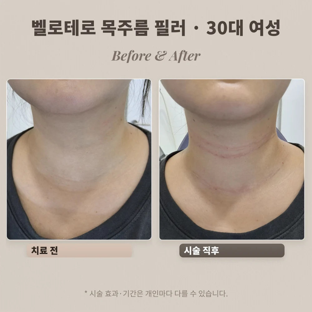 30대 여성 히알루론산 필러 벨로테로 목주름 시술 전과 시술 직후 비교
