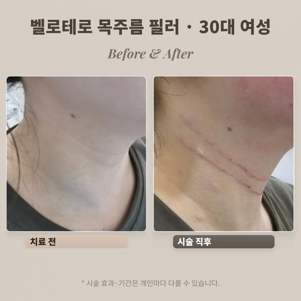 30대 여성 옆목 주름 벨로테로 필러 시술 전과 시술 직후 비교
