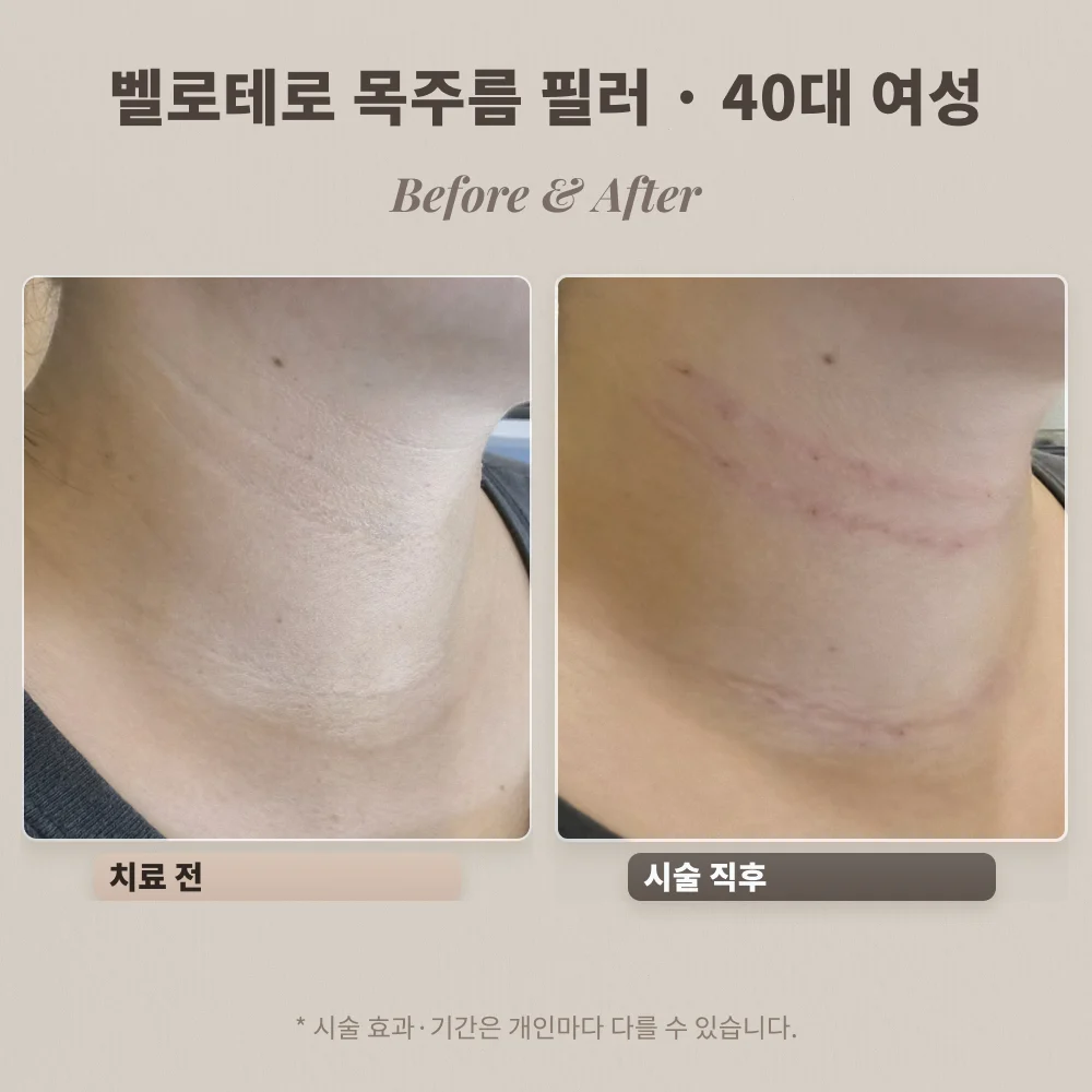 40대 여성 옆목 주름 벨로테로 필러 시술 전과 시술 직후 비교