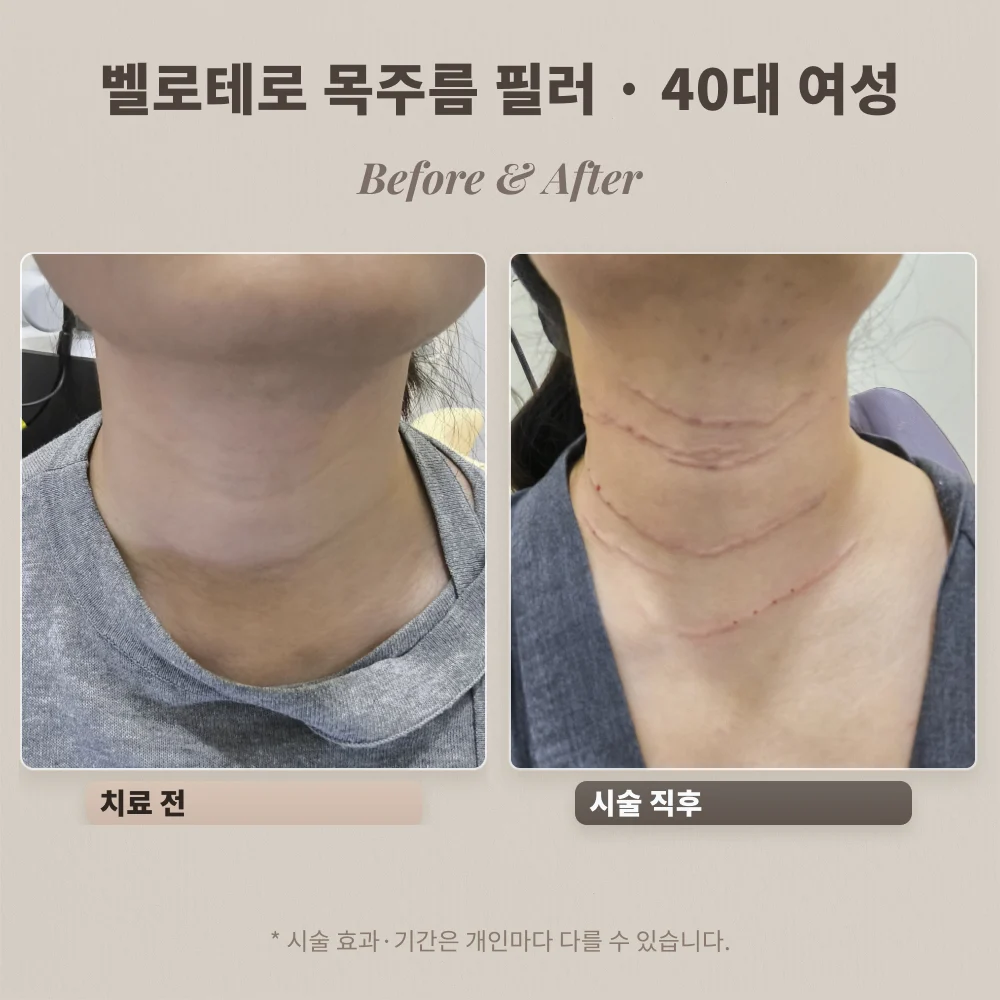 40대 여성 여러 줄 목주름 벨로테로 필러 시술 전과 시술 직후 비교