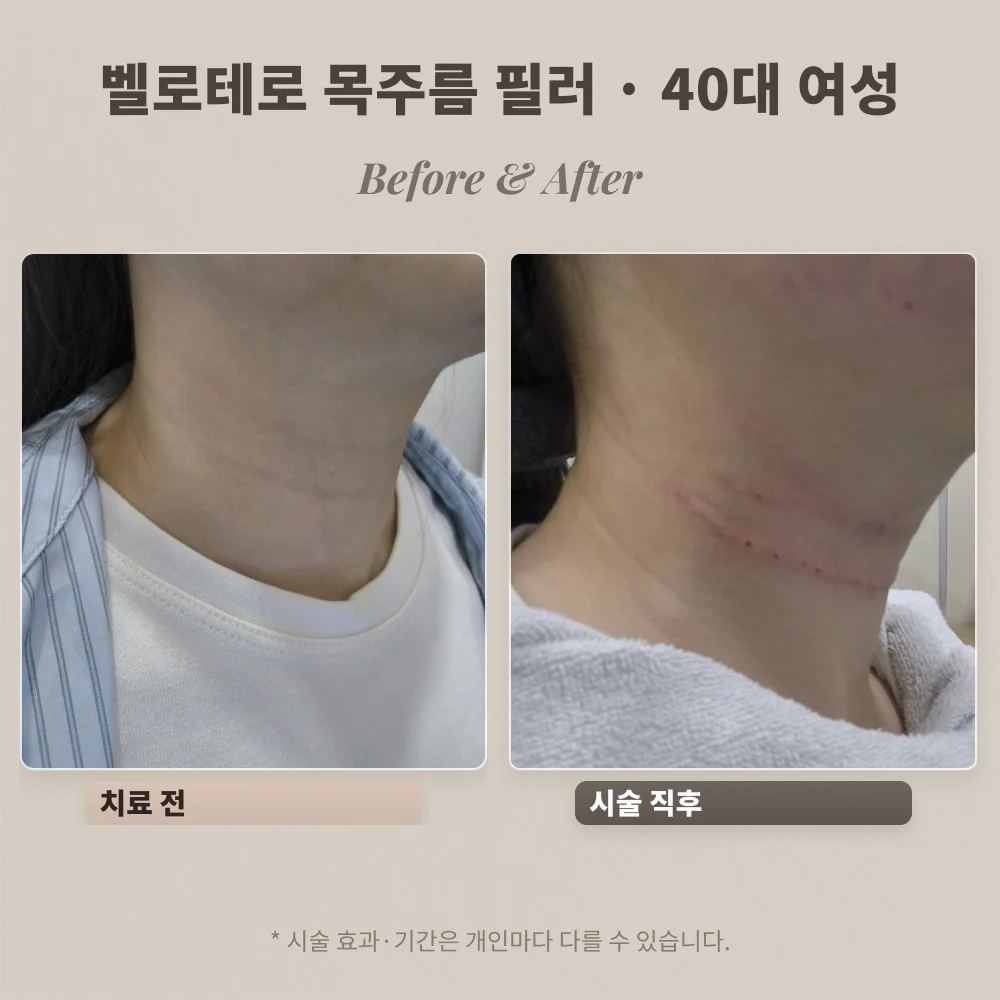 40대 여성 벨로테로 목주름 필러 시술 전과 시술 직후 비교