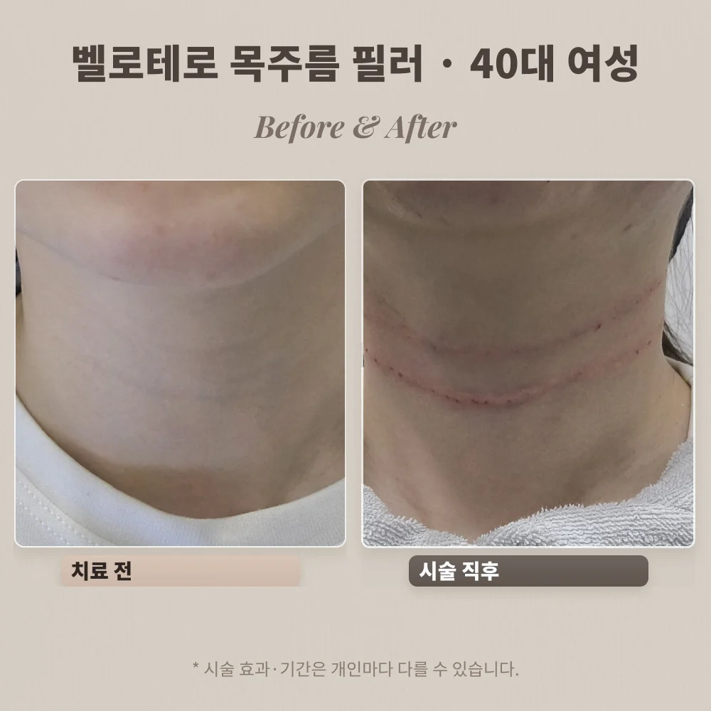 40대 여성 벨로테로 목주름 필러 시술 전과 시술 직후 비교