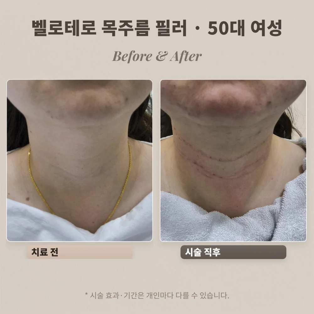 50대 여성 벨로테로 목주름 필러 시술 전과 시술 직후 비교