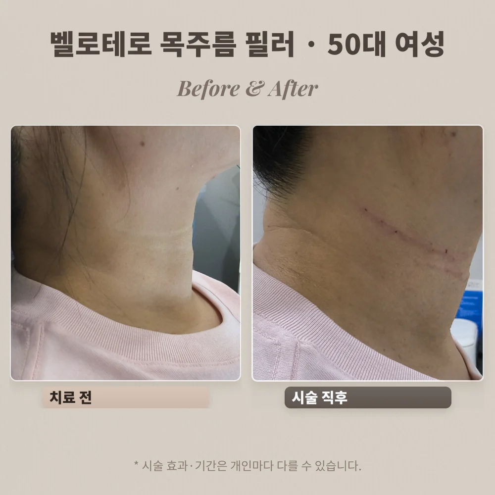 50대 여성 옆목 주름 벨로테로 필러 시술 전과 시술 직후 비교
