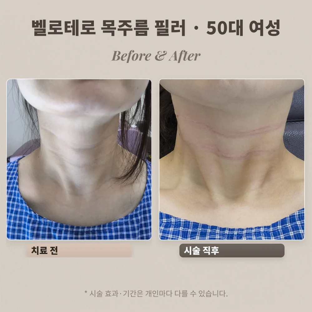 50대 여성 두 줄 목주름 벨로테로 필러 시술 전과 시술 직후 비교