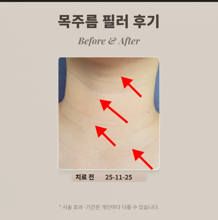 목주름 필러 후기