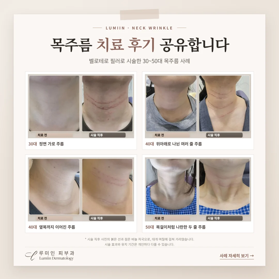 목주름 치료 후기 공유합니다