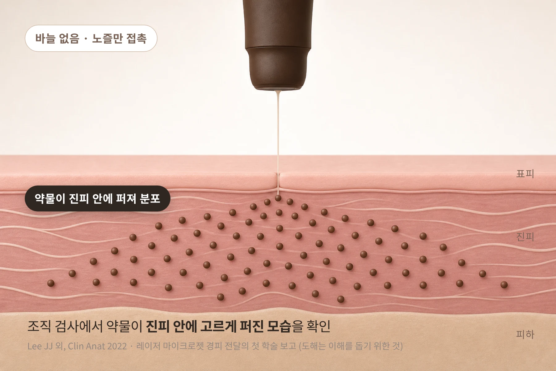바늘 없는 노즐에서 들어간 약물이 진피 안에 고르게 퍼져 있는 피부 단면 도해
