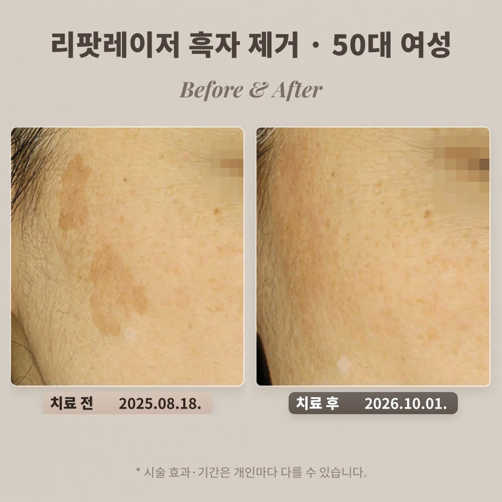 50대 여성 볼 부위 큰 흑자 리팟레이저 치료 전과 치료 후 비교