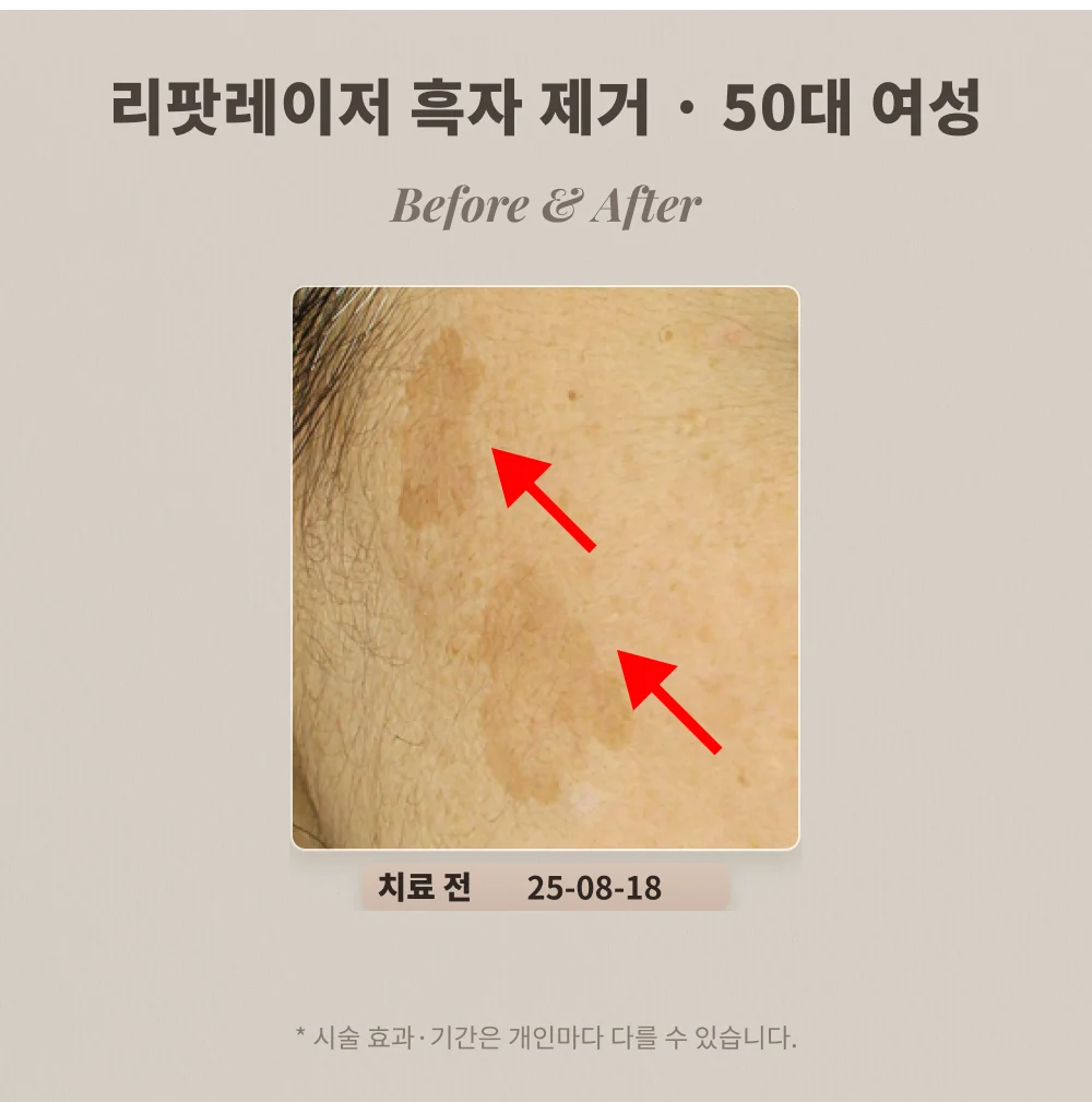 50대 여성 볼 부위 큰 흑자 리팟레이저 시술 전 확대