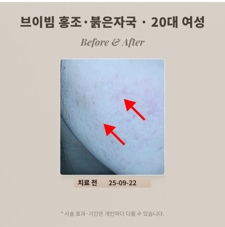 홍조·주사피부염 브이빔 치료 후기, 20대 여성 볼 구진과 붉은 자국