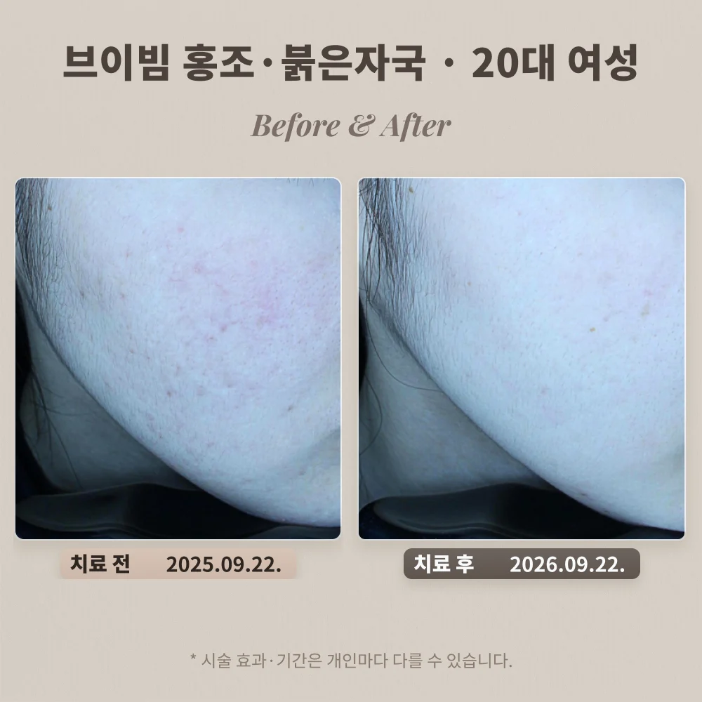 20대 여성 볼 홍조·붉은 자국 브이빔 치료 전과 치료 후 비교