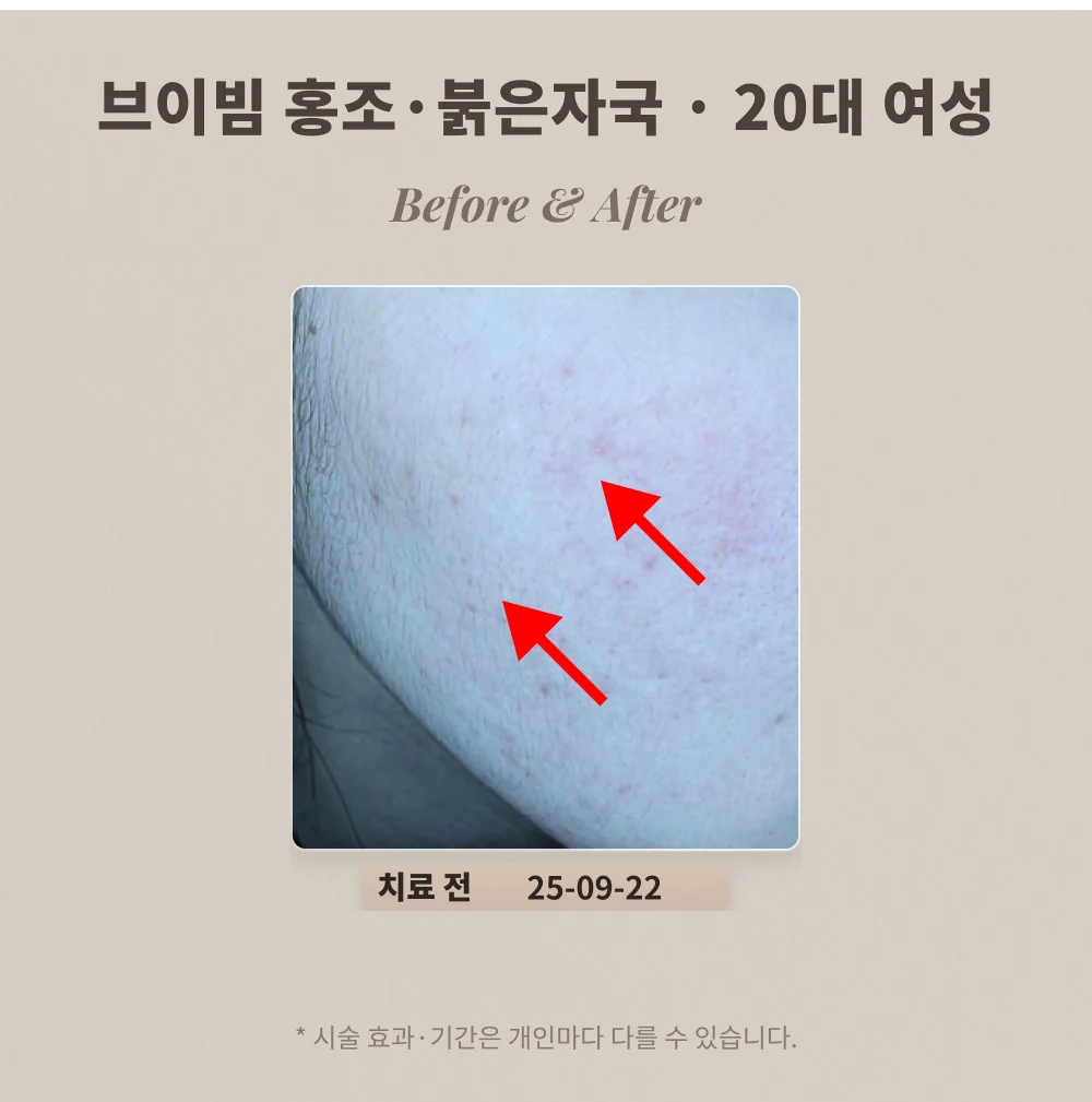 20대 여성 볼 홍조·붉은 자국 브이빔 치료 전 확대