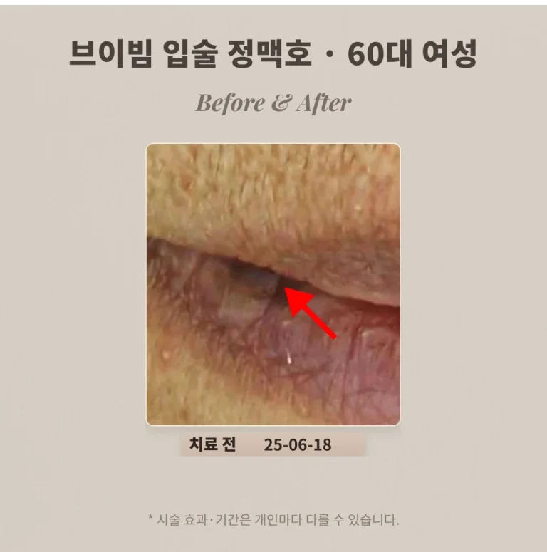 입술 정맥호 브이빔 치료 후기, 60대 여성 윗입술 보라색 병변