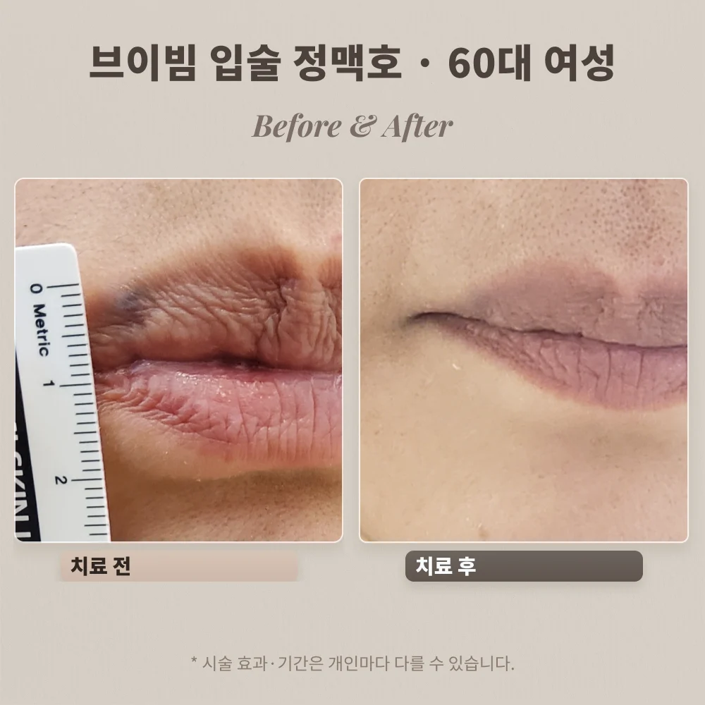60대 여성 입술 정맥호 브이빔 치료 전 자로 크기 측정 사진과 치료 후 비교