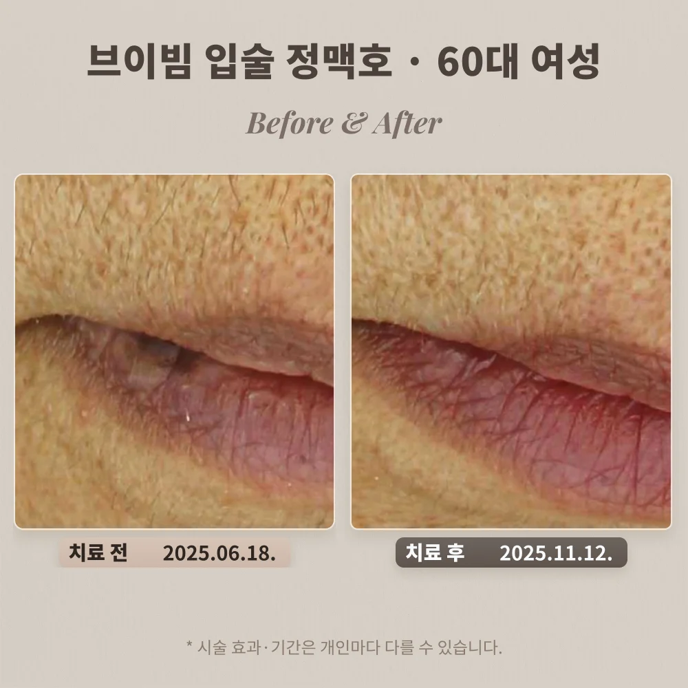 60대 여성 입술 정맥호 브이빔 치료 전과 치료 후 비교